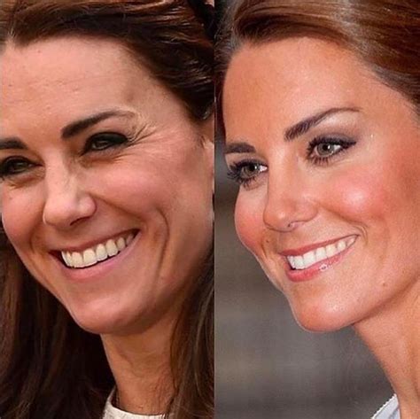 kate middleton operación